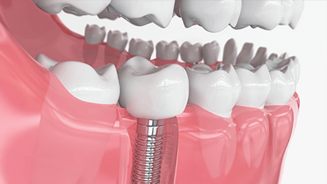 人工种植牙的治疗过程