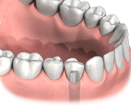 患有牙龈炎能否做种植牙