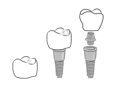 牙槽突裂植骨术应在何时进行-分析唇腭裂牙槽植骨几岁做好!