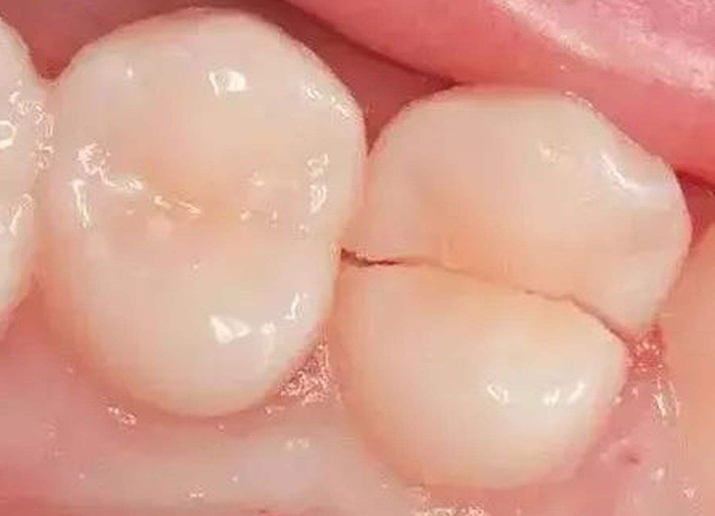 牙齿出现缱隙怎么办？