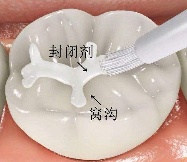 您的孩子牙齿做了窝沟封闭了吗？