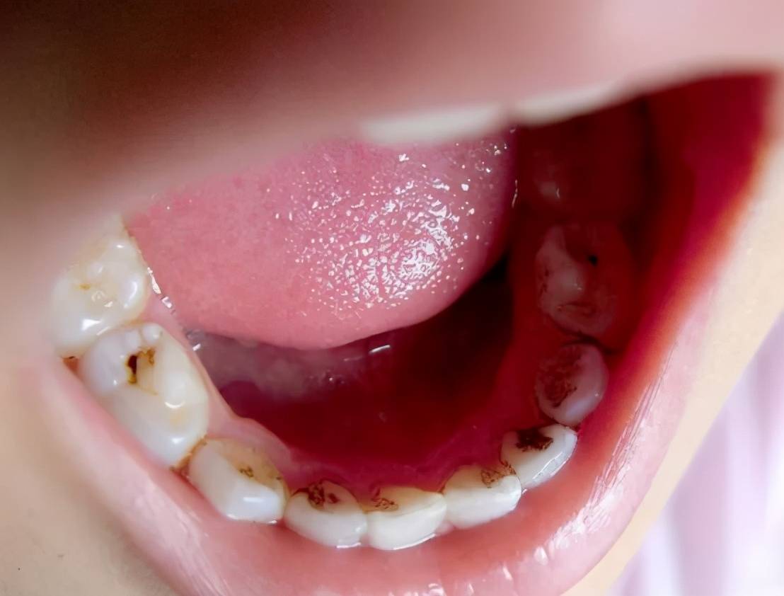 儿童牙齿表面的白色或黄褐色现块是怎么回事