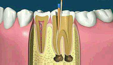 牙髓干髓治疗有哪些问题？