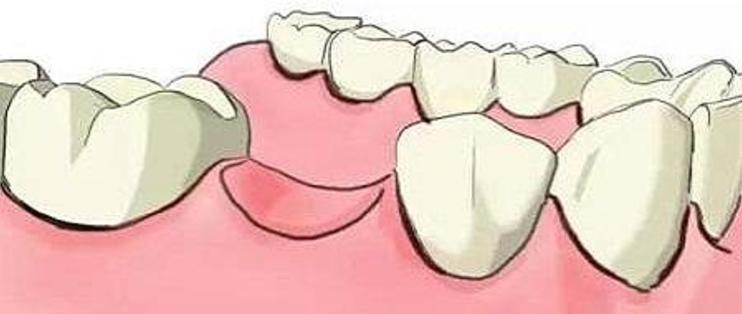 牙齿完全脱落应如何治疗？