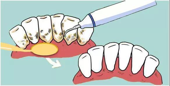 一直有个疑问：补过的牙齿洗牙会洗掉吗？