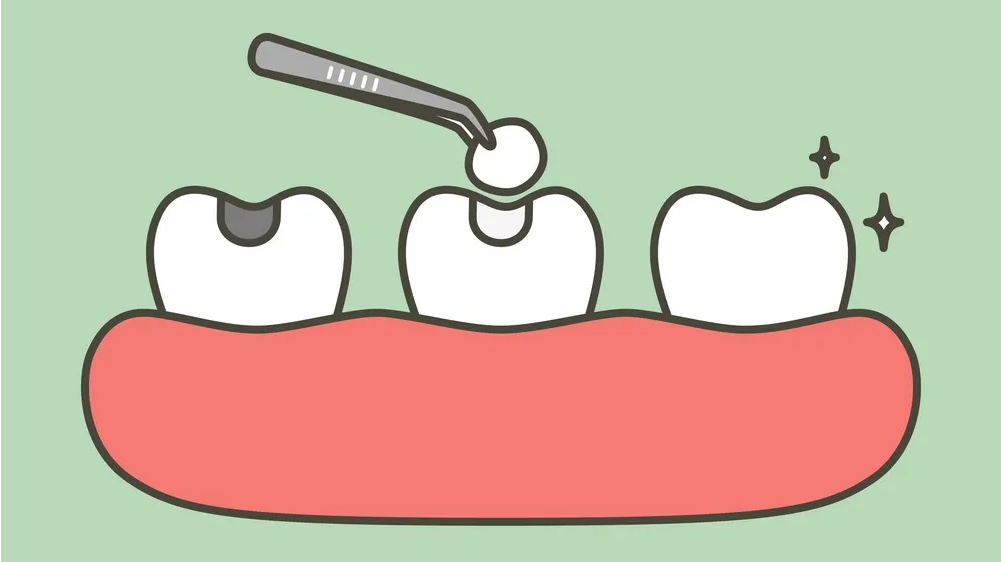 愛牙科普 - 關於補牙，你了解多少？