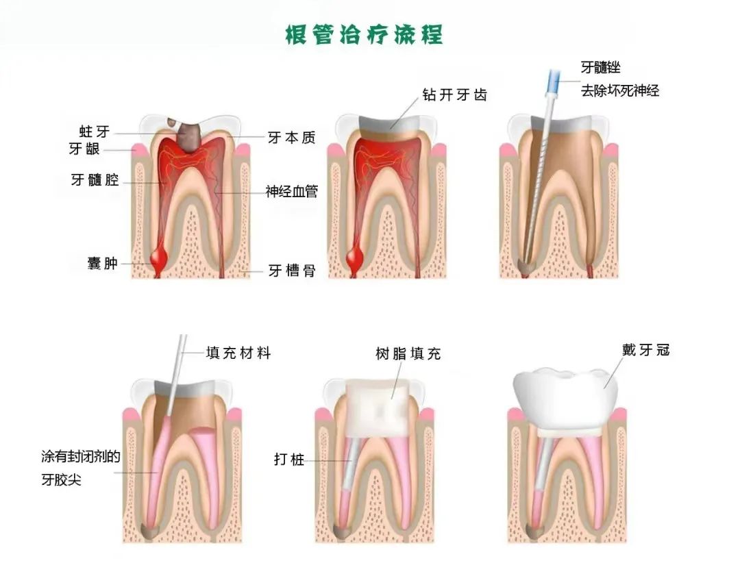 根管治疗后戴个牙冠，是医生忽悠你？