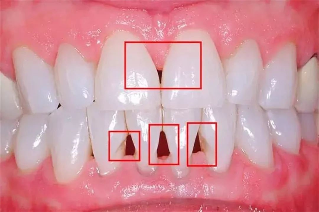 牙齒嘅“黑三角”，比蛀牙更驚人