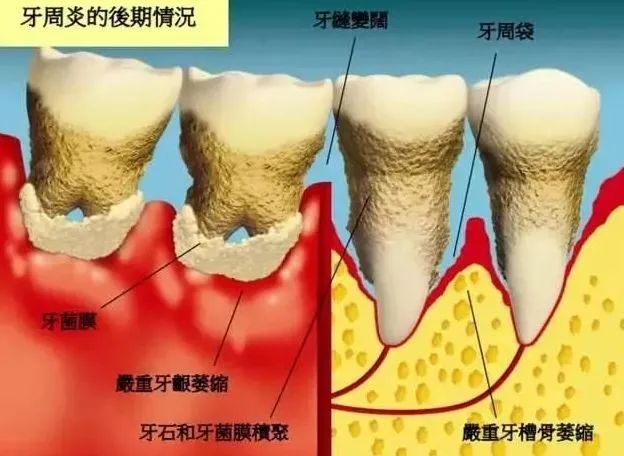 牙齒殺手，牙周炎嘅前世今生.....