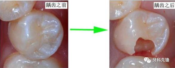 塞牙都係一種病？解決方法送俾你！