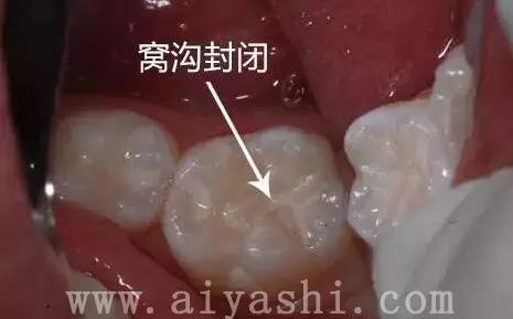 小朋友牙齿上的黑色素能去掉吗？