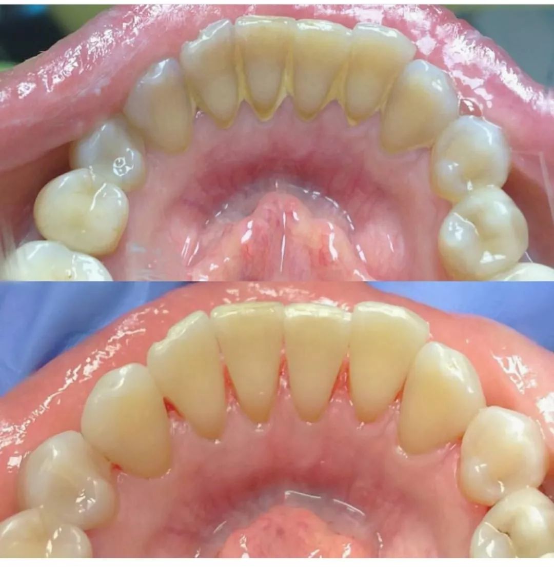 牙医遇见最烂的牙齿到底有多烂？