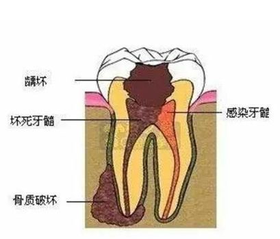 根管治疗策略是取决于其是否感染