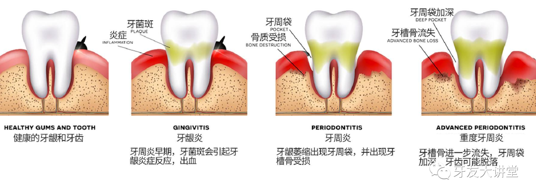 【牙周炎】正在杀死95%中国人的“牙齿”！