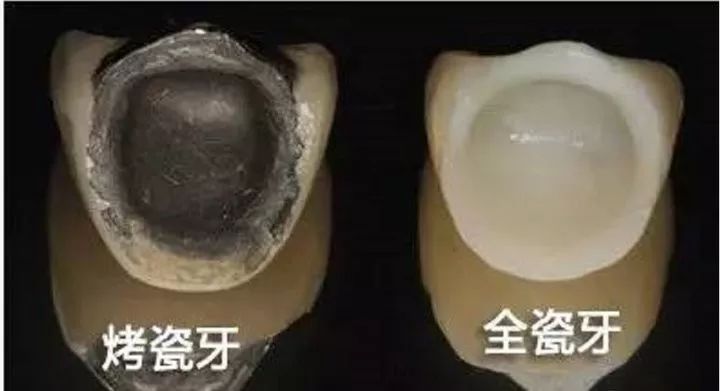 烤瓷牙与全瓷牙应怎样选？