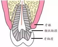 早上先吃饭还是先刷牙？90%都错了！