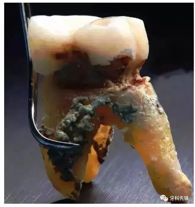 多年不洗牙牙结石堆成钟乳石！ 是时候放下对洗牙的偏见了！