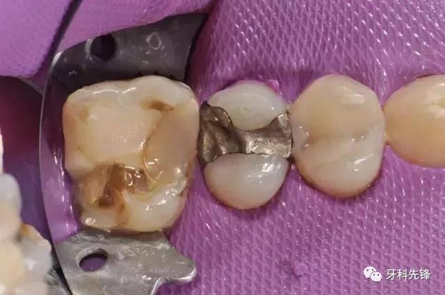 补牙全过程看看牙医在你嘴里做了什么？