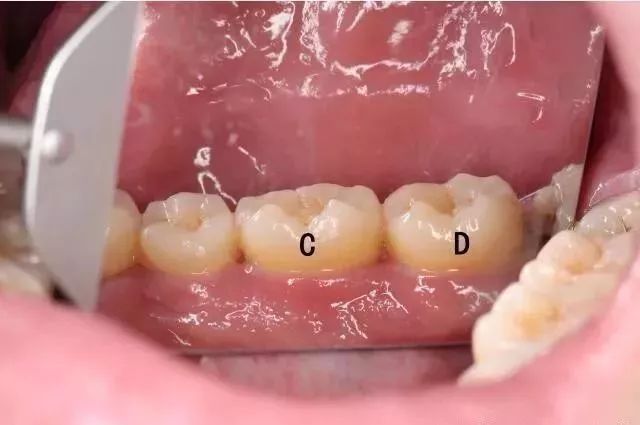 固定义齿修复后可能出现的问题及处理方法！
