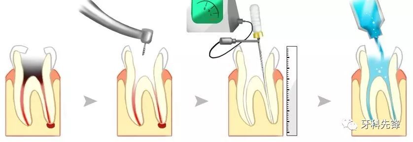 根管治疗的收费标准原来是这样