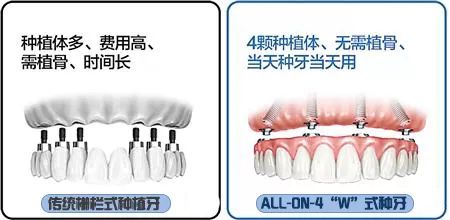 几千和一两万的种植牙到底差在哪里？