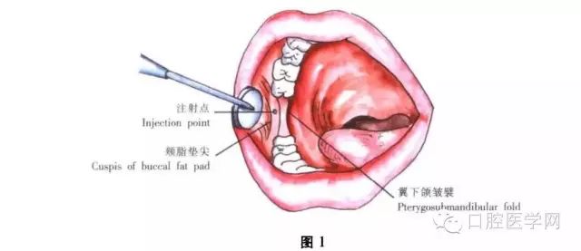 孩子【乳牙蛀了】不用管换完牙就好了？这句话坑了多少娃！