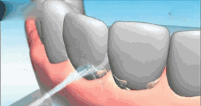 牙齿出血到底是怎麼回事？
