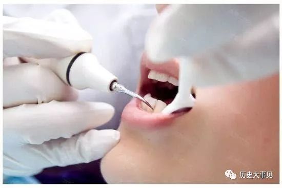 牙科医生为什麼建议要洗牙- 洗牙对牙齿真的有损伤吗- 别想太多!