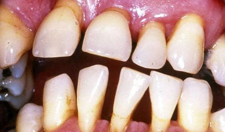 牙齿越长越长？你可能被牙齦萎缩盯上了！