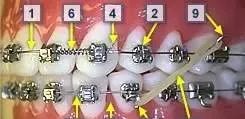 牙齿矫正知识科普帖：正畸牙套装置部件详解（附图片）
