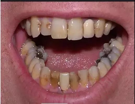 牙齿有了【小黑点】如不管、到【失去牙齿】要几步？
