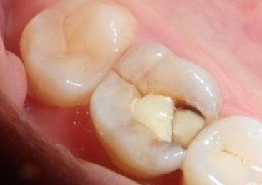 牙齿突然掉了一小块是怎麼回事？