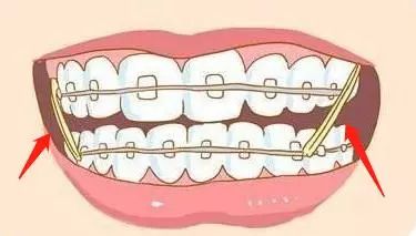 牙齿矫正时戴的小皮筋有什麼用？