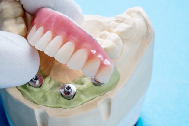 镶假牙，哪种材质适合你？