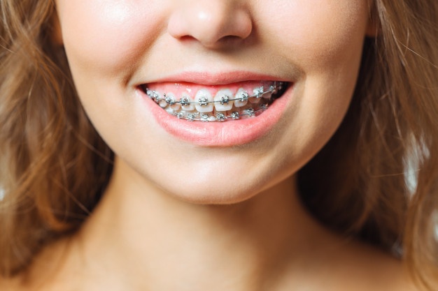 woman-smiling-with-braces_168410-478