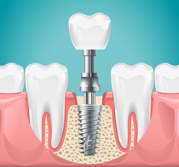 dental-surgery-tooth-implant-poster_80590-7852