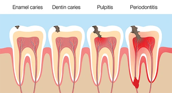teeth-caries-tooth-260nw-1991876021
