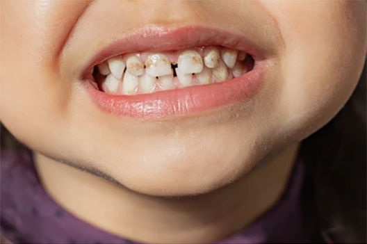 child-shows-teeth-hypoplasia-pediatric-260nw-2139128093