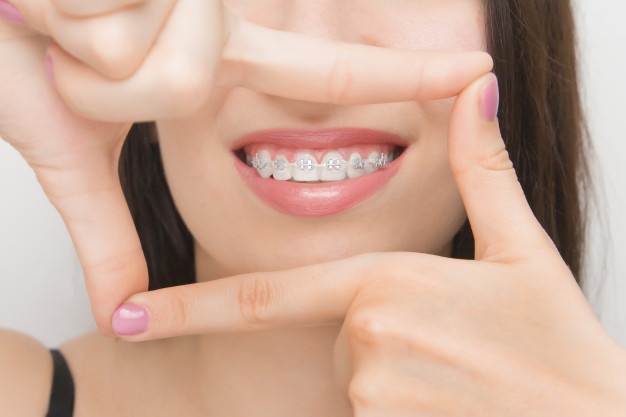 dental-braces-happy-woman-s-mouths-through-frame-brackets-teeth-after-whitening-self-ligating-brackets-with-metal-ties-gray-elastics-rubber-bands-perfect-smile_177415-333