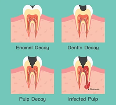 tooth-decay-vector-260nw-143851411