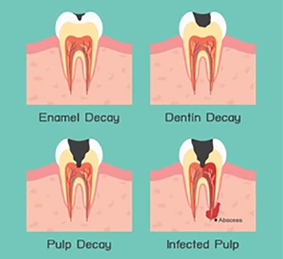 tooth-decay-vector-260nw-143851411 tooth-decay-vector-260nw-143851411