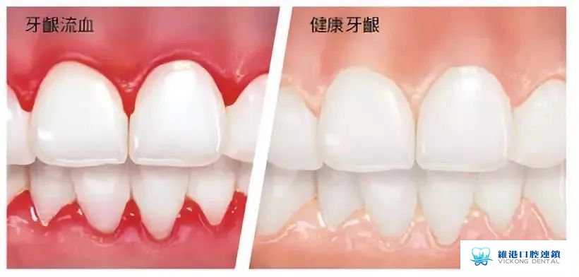 牙龈出血