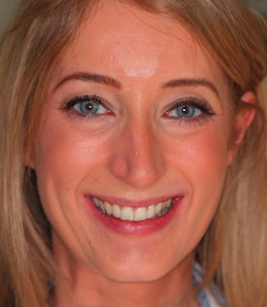 Invisalign