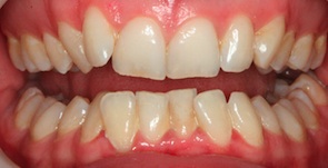 Invisalign