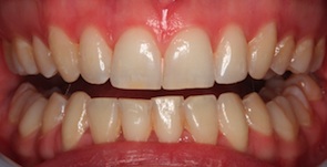 Invisalign