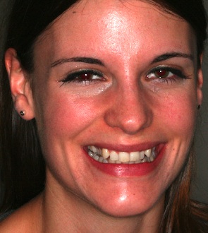 Invisalign