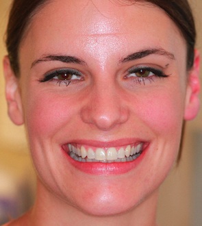 Invisalign