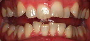 Invisalign