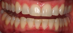 Invisalign