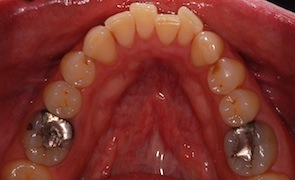 Invisalign